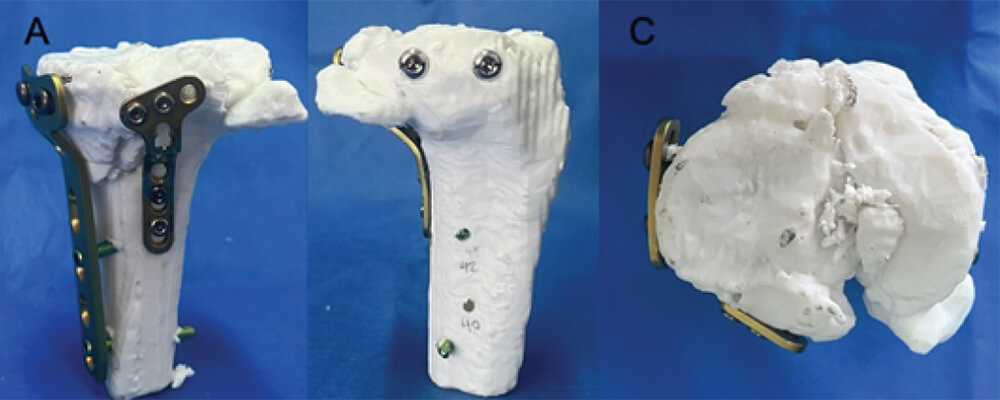 Figura 4: Fotos clínicas de la impresión 3D de tibia proximal donde se evidencian la reducción y fijación con material de osteosíntesis. A) visión posteromedial. B) lateral. C) visión axial.