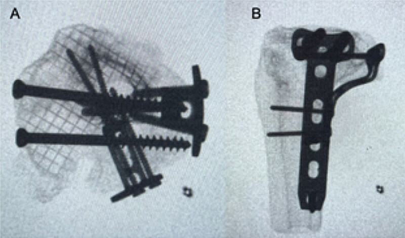 Figura 5: Fotos clínicas de la impresión 3D de tibia proximal donde se evidencian la reducción y fijación con material de osteosíntesis bajo imagen fluoroscópica. A) visión axial. B) lateral.