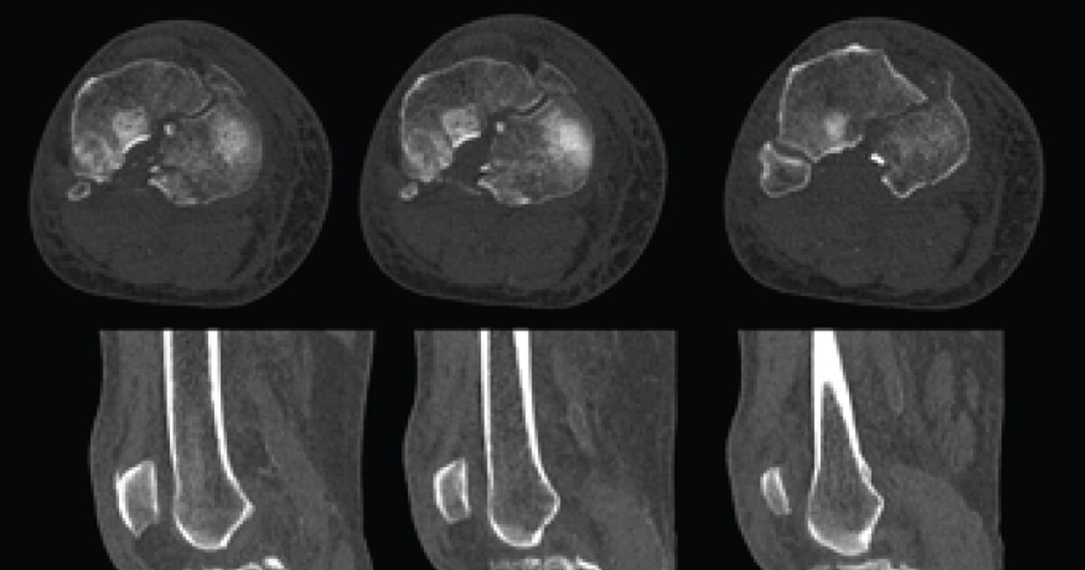 Planificación preoperatoria mediante el uso de impresión 3D para fracturas de meseta tibial