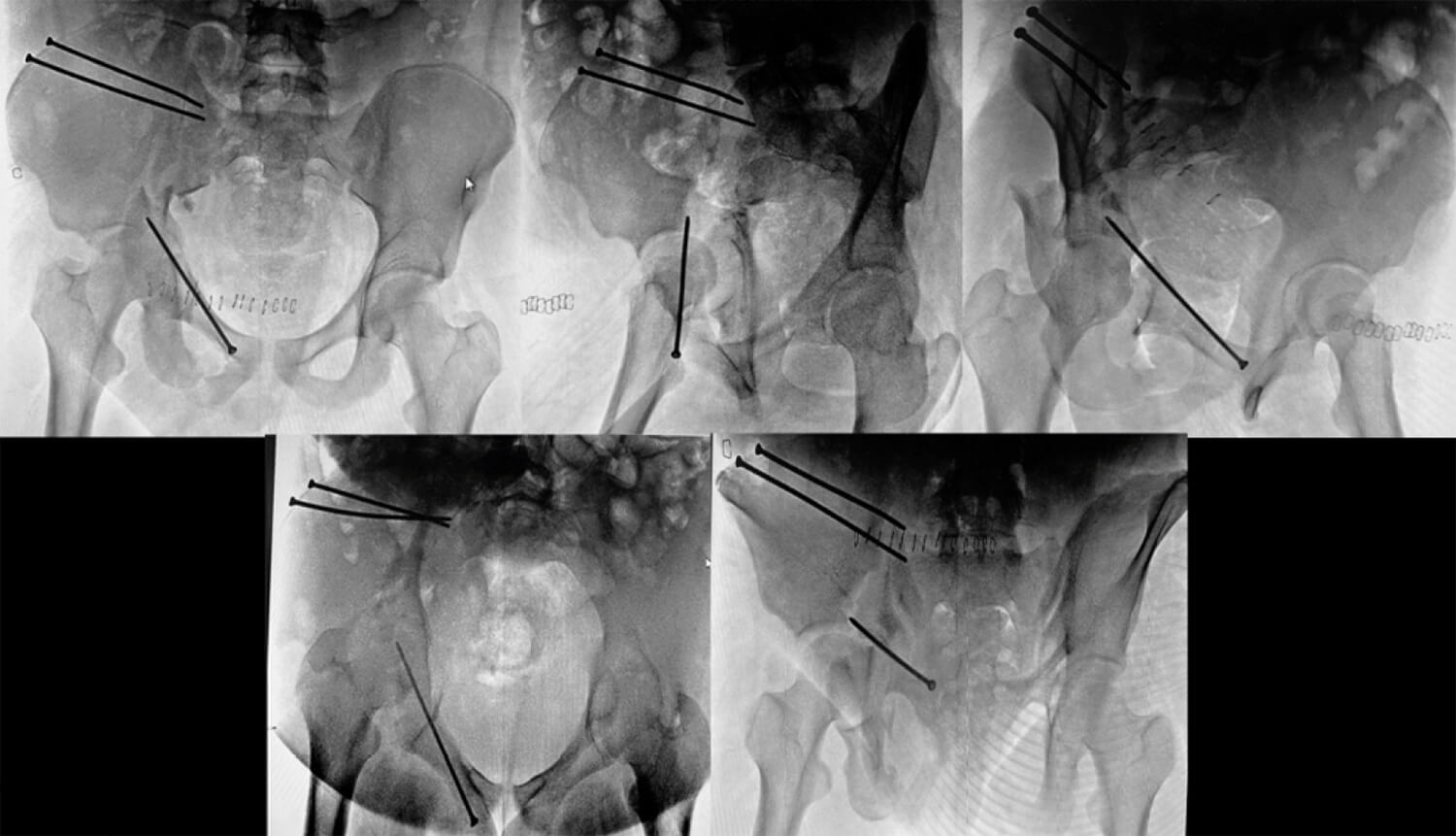 Figura 1: Proyecciones radiográficas estándar (Serie de Judet, AP de pelvis, Inlet y Outlet) estándar donde se observa compromiso de la línea iliopúbica e isquiopúbica derecha, columna anterior con reducción y fijación interna fallida, columna posterior con desplazamiento mayor a 20mm.