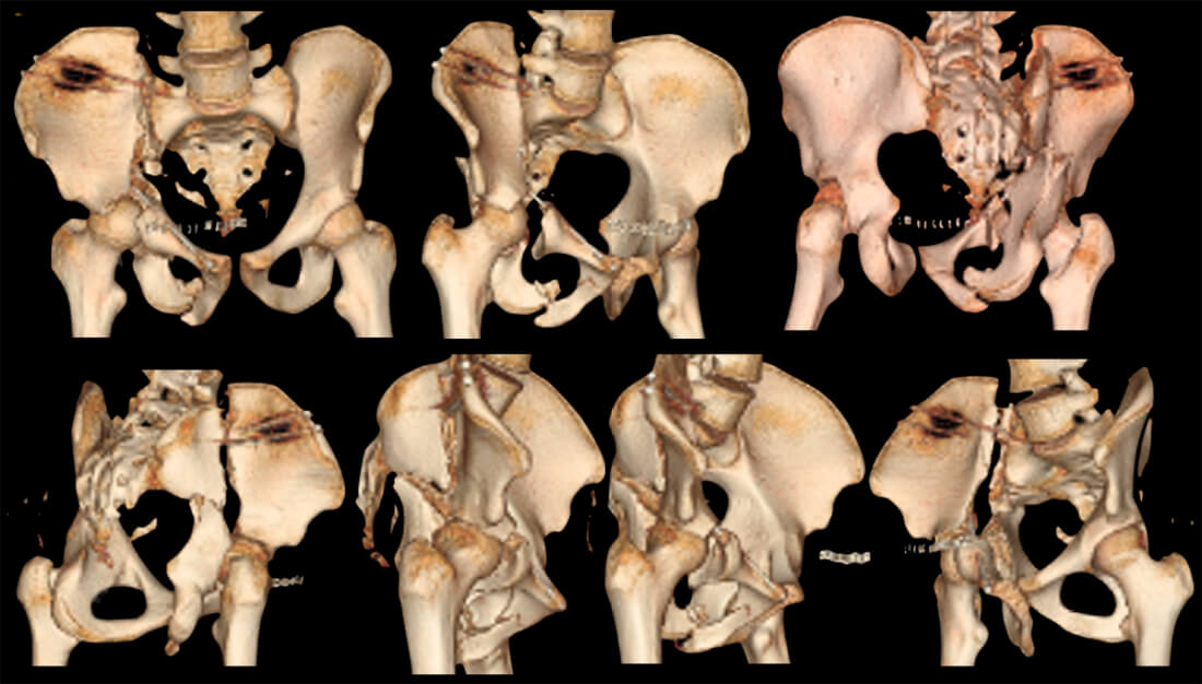 Figura 2: TAC de pelvis con reconstrucción 3D previa a la osteosíntesis de revisión: Se observa ambas columnas de acetábulo derecho separadas entre sí, con un desplazamiento > a 20 mm y también con respecto al esqueleto axial, de modo que no existe conexión entre la superficie articular y el esqueleto del tronco. En la zona de la fosa iliaca se encuentra la línea de fractura principal que se extiende hasta la cresta iliaca. La fractura de la columna posterior se extiende hasta la parte alta del agujero ciático mayor.