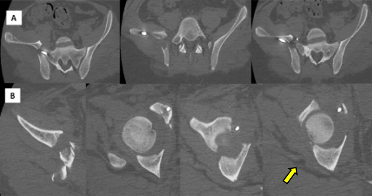 Figura 3: A. TAC Cortes axiales: Se observa el desplazamiento del ala iliaca, tornillo 3,5 mm que se encuentra fuera de la cortical ósea del ilion (flecha amarilla). B. TAC Cortes axiales: Se observa la ausencia de reducción de ambas columnas de acetábulo derecho.