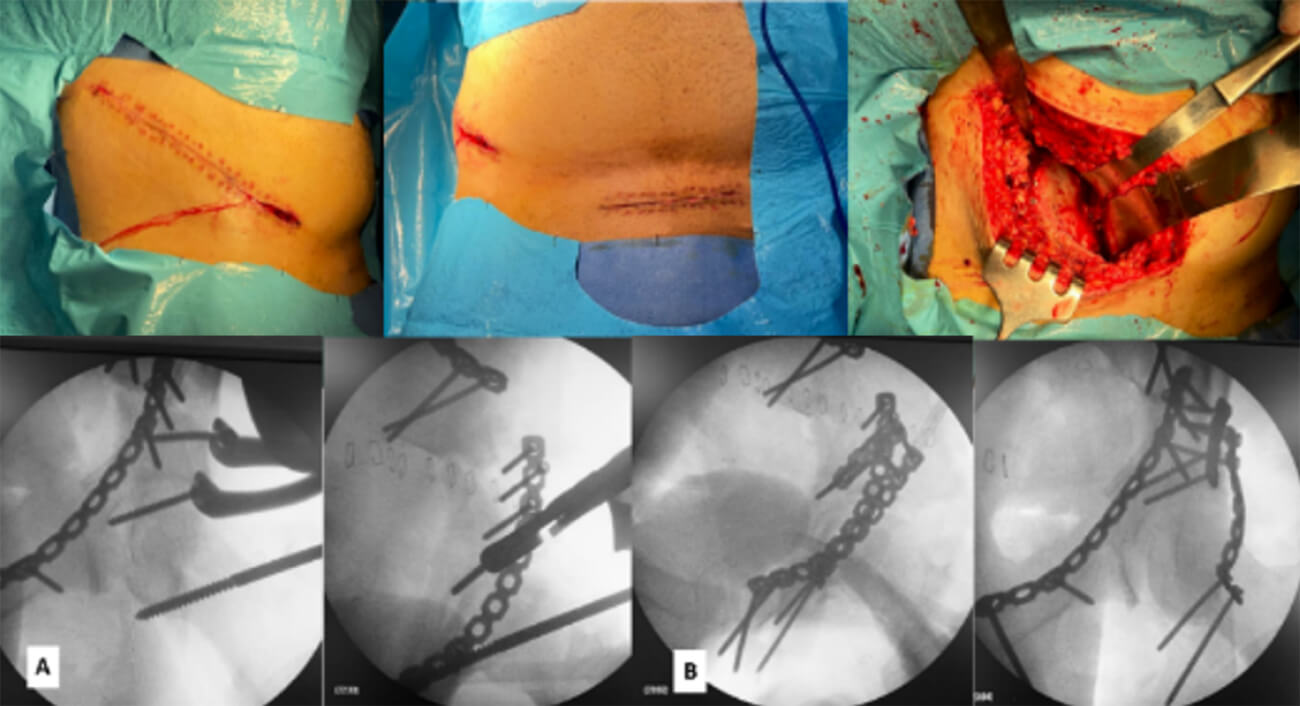 Figura 5: Se realiza un enfoque a través de abordaje de cirugía previa (ventana I del abordaje Ilioinguinal) y Stoppa modificado. A. Reducción y fijación interna estable a lo largo de toda la columna anterior y lamina cuadrilátera con sistema de placa de reconstrucción y tornillos 3,5mm. B. Reducción anatómica y fijación interna estable en la columna posterior con sistema de placa de reconstrucción y tornillos 3,5mm.