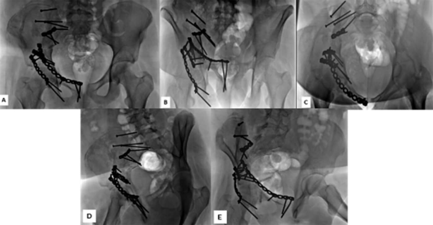Figura 6: Doce meses del postoperatorio. A. Se restablece las líneas de referencia anatómicas del acetábulo, reducción anatómica de la línea iliopectínea que corresponde a la columna anterior, simetría del agujero obturador. Reducción anatómica de la columna posterior. B y C. Radiografía outlet e inlet de se evidencia la reducción anatómica de ambas columnas. D. Rx. Oblicua alar, se observa reducción anatómica de la columna posterior, integridad de la escotadura ciática mayor, espina ciática. E. Oblicua Obturatriz, reducción anatómica de la columna anterior.