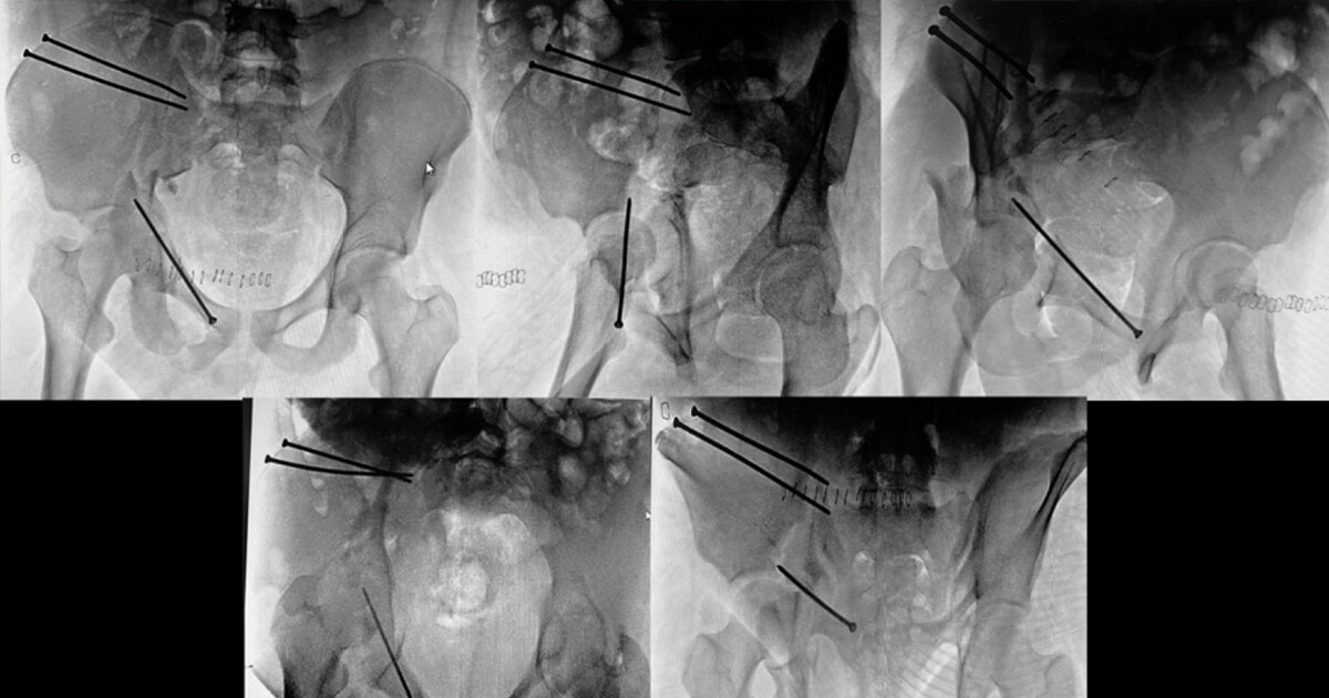 Cirugía reconstructiva en osteosíntesis fallida de acetábulo. Evitando la  progresión a osteoartrosis temprana. Reporte de Caso