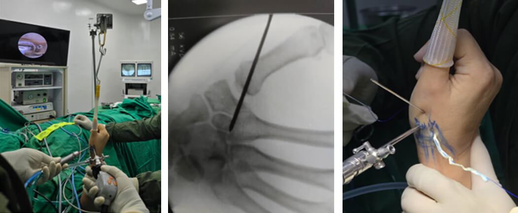 Figura 1: Técnica quirúrgica asistida por artroscopia y fluoroscopia.