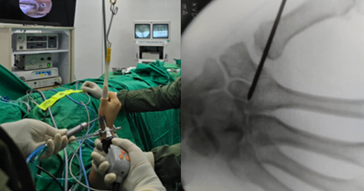 Rizartrosis tratada mediante cirugía artroscópica: Resultados y consideraciones