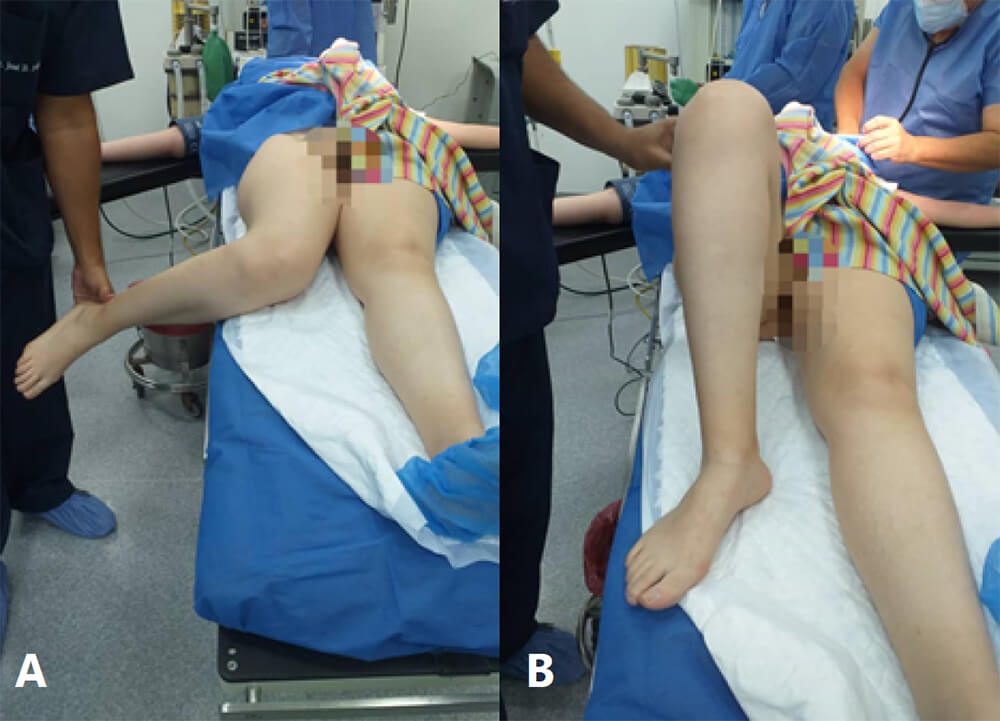 Figura 2: A. Anteversión femoral aumentada. B. Torsión tibial externa excesiva.
