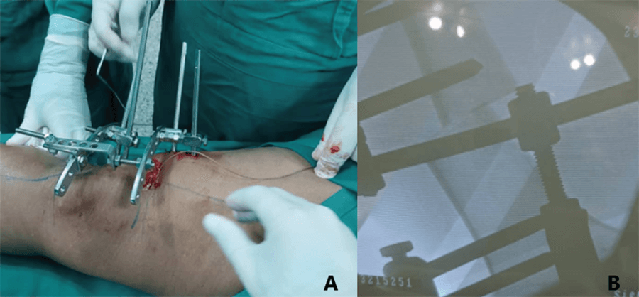 Foto 1. A) Previa osteotomía con sierra de Gigli en zona de seguridad. B) Posterior realización de osteotomía femoral distal y efecto de traslación para realineación del eje mecánico al centro de la rodilla.